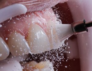 دستگاه جرمگیری دندانپزشکی