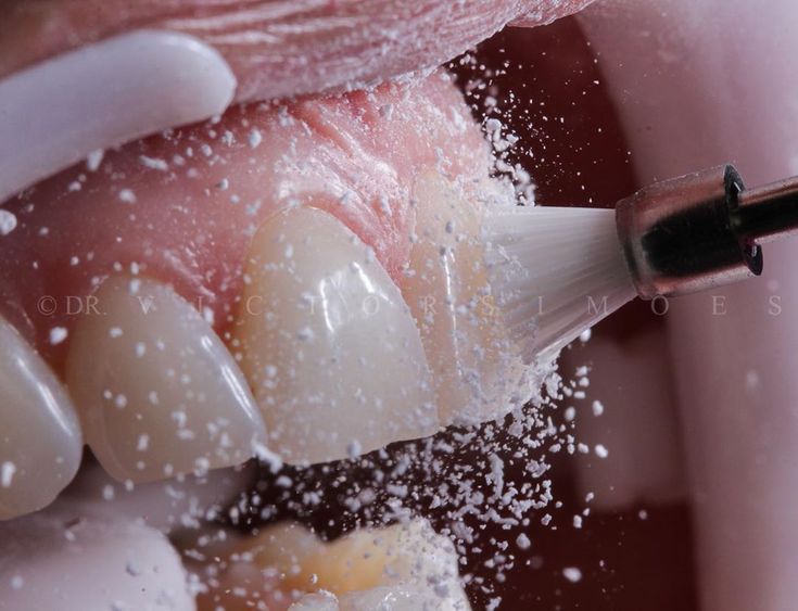 دستگاه جرمگیری دندانپزشکی